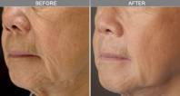 Chicago Laser Wrinkle Reduction